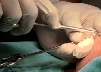 Vasectomía sin bisturí procedimiento quirúrgico&nbsp;gratuito, rápido, seguro y efectivo: SSO