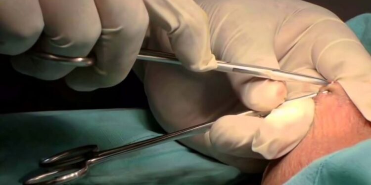 Vasectomía sin bisturí procedimiento quirúrgico&nbsp;gratuito, rápido, seguro y efectivo: SSO