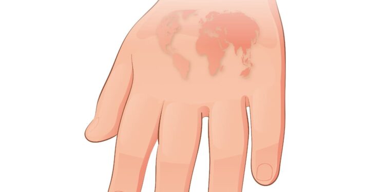 Intensifica SSO acciones en la lucha contra la lepra