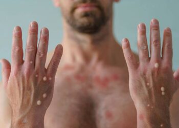 Viruela del mono en México: Estos son los estados con más casos confirmados