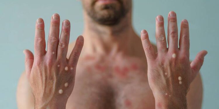 Viruela del mono en México: Estos son los estados con más casos confirmados