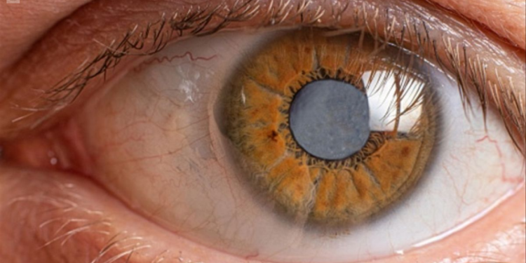 Realizarán Jornada de Detección de Catarata