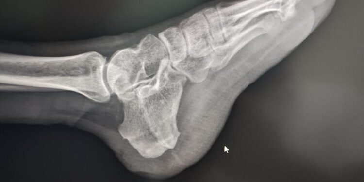 Después de 7 años, cuenta Hospital de Tuxtepec con nueva Unidad Radiológica Digital para estudios de Tórax